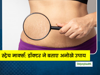 स्ट्रेच मार्क्स को पड़ने से रोकने के लिए 7 घरेलू नुस्खे बता रही हैं एक्सपर्ट